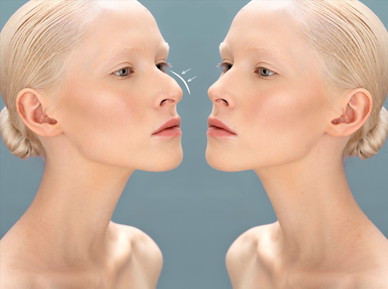 Bild zur Nasenkorrektur